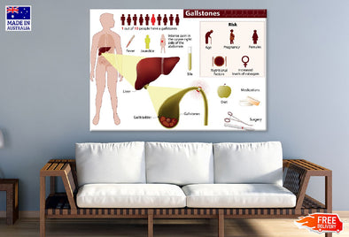 Human Gallstones Vector Illustration Print 100% Australian Made Stretched Canvas Ready to Hang - 2391